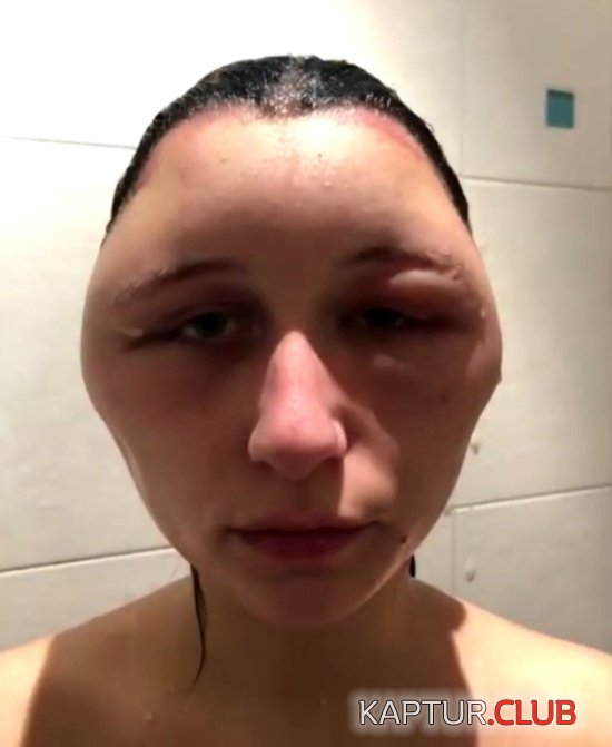 allergy_hair_dye_06.jpg | Рено Каптур Клуб Россия | Форум KAPTUR.SU