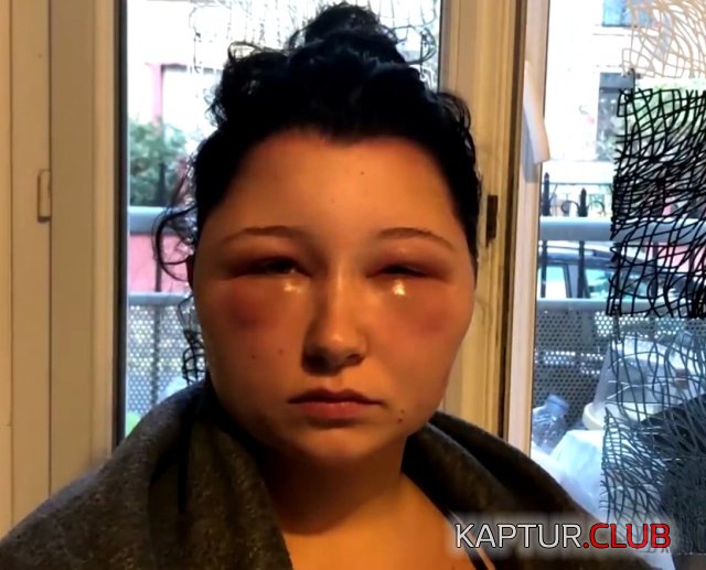 allergy_hair_dye_07.jpg | Рено Каптур Клуб Россия | Форум KAPTUR.SU
