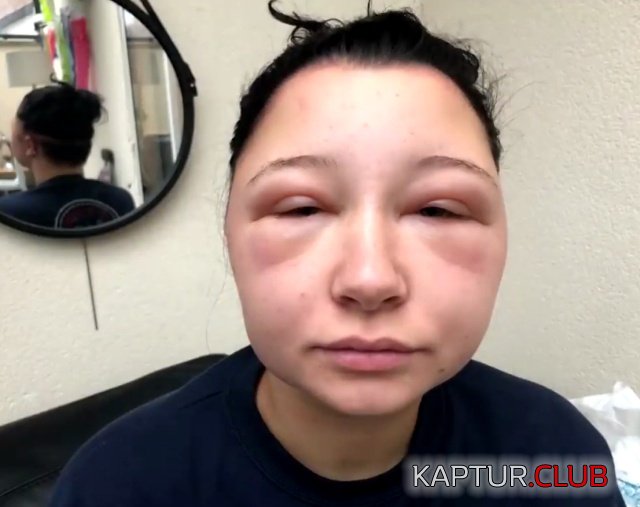 allergy_hair_dye_09.jpg | Рено Каптур Клуб Россия | Форум KAPTUR.SU